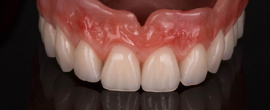 Съемное зубное протезирование